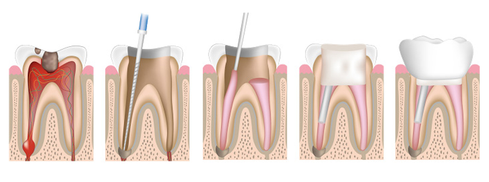 Endodontia - conhecido como tratamento de canal